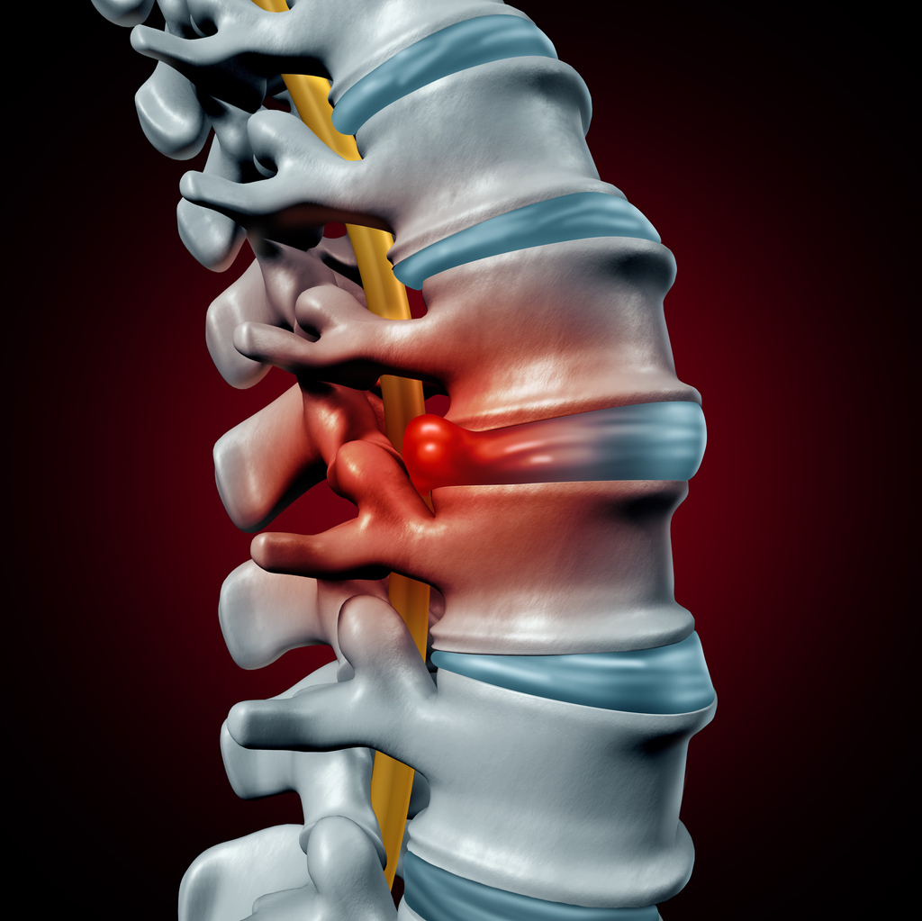 lumbar-microdiscectomy-surgery-st-louis.jpg