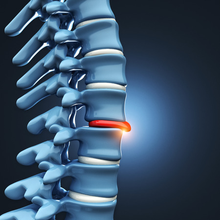 65459583-3d-image-of-herniated-disk-human-spinal.jpg